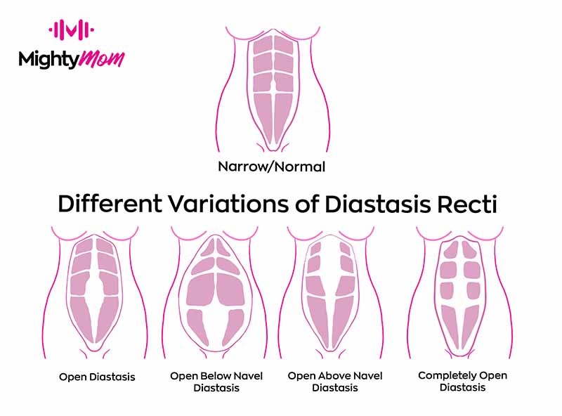 Diastasis Recti